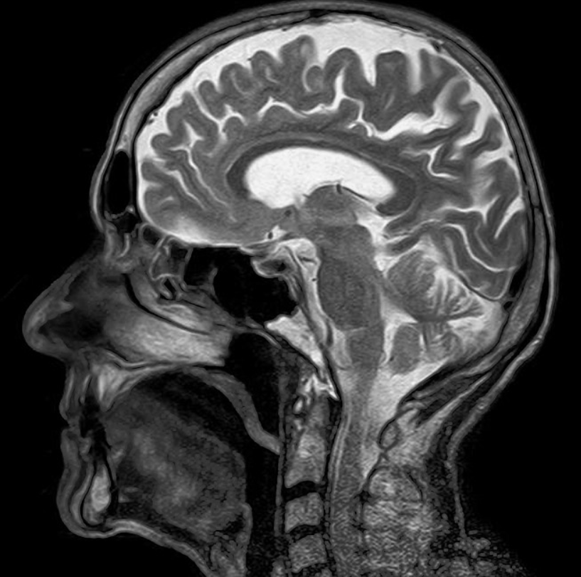 Fort Lauderdale brain injury lawyer