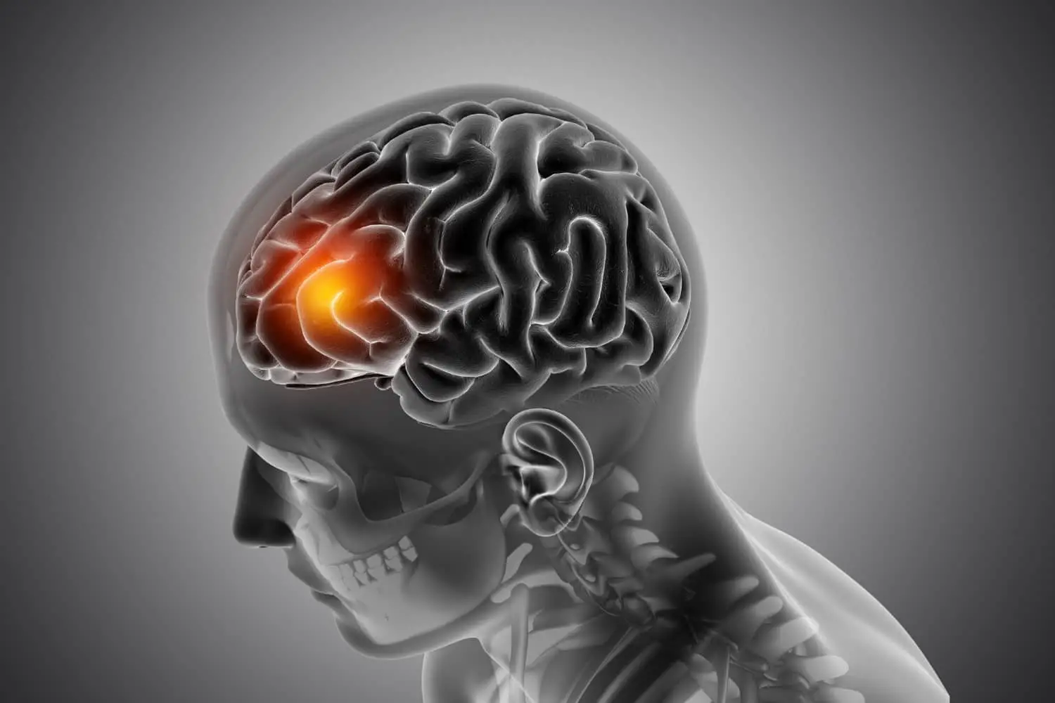 Diminished Intellectual Abilities - Traumatic Brain Injury Attorney Fort Lauderdale